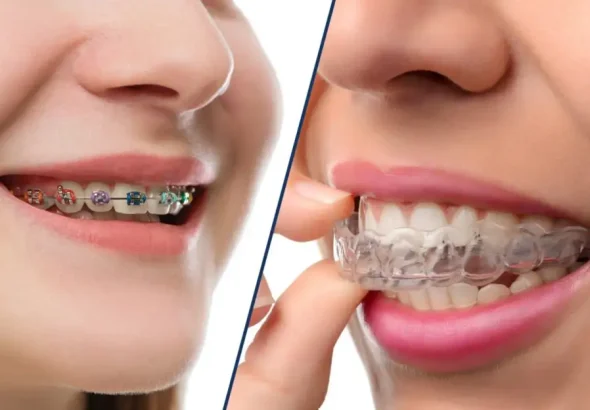 Invisalign Vs Braces Key Differences Every Patient Should Know