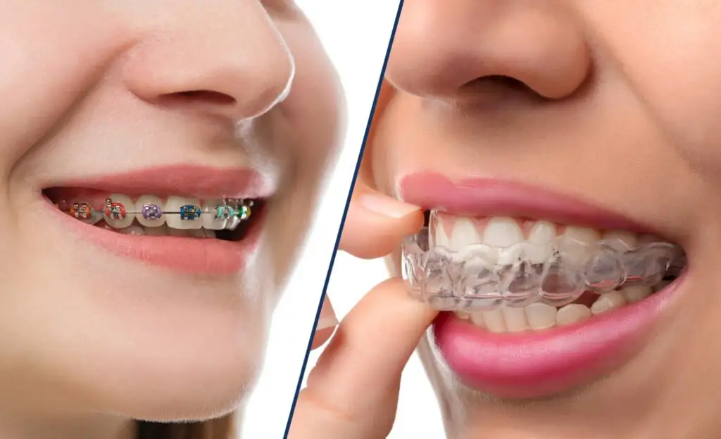 Invisalign Vs Braces Key Differences Every Patient Should Know